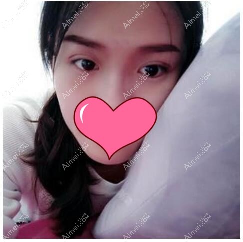 双眼皮术后1个月恢复效果 双眼皮术后1个月恢复效果