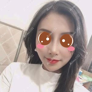 做肋软骨隆鼻后3个月 做肋软骨隆鼻后3个月