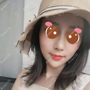 做肋软骨隆鼻后半个月恢复 做肋软骨隆鼻后半个月恢复