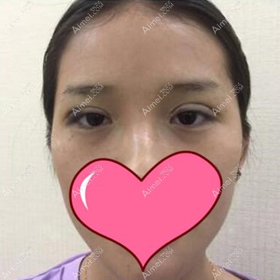 双眼皮术后即刻 双眼皮术后即刻