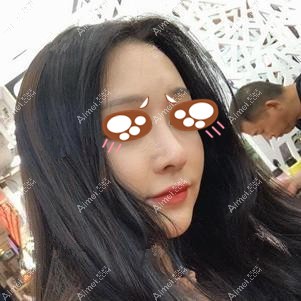 在党宁医生做耳软骨隆鼻术后4个月对比 在党宁医生做耳软骨隆鼻术后4个月对比