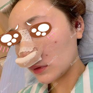 在重庆联合丽格做耳软骨隆鼻当天 在重庆联合丽格做耳软骨隆鼻当天