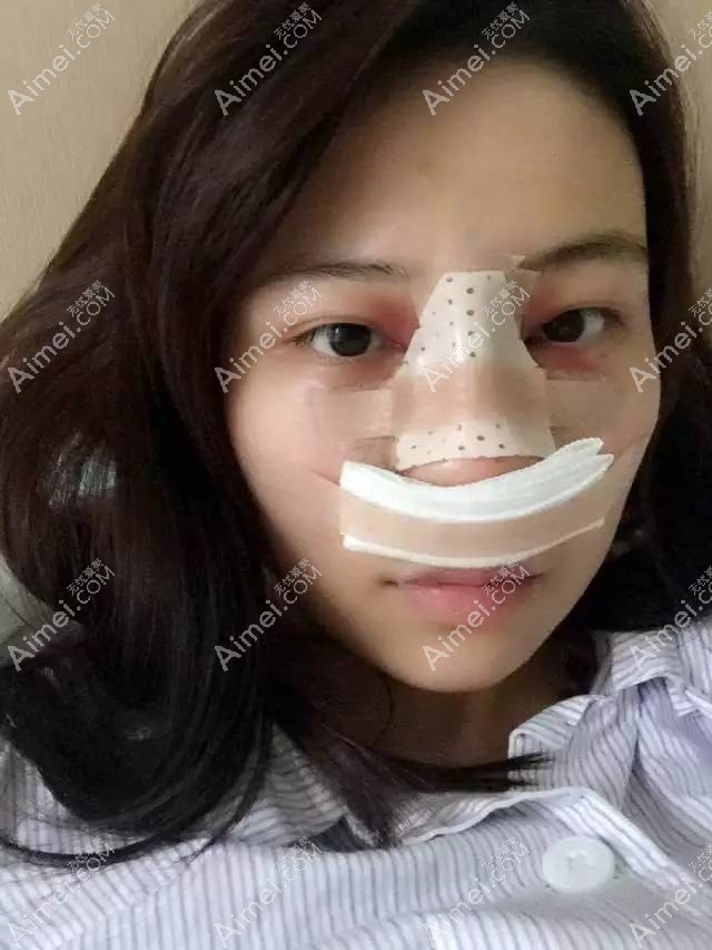 隆鼻术后第二天恢复中 隆鼻术后第二天恢复中