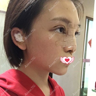 江门华美双眼皮+开眼角+鼻综合案例 江门华美双眼皮+开眼角+鼻综合案例