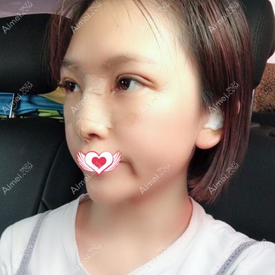 江门华美眼综合+膨体隆鼻+耳软骨垫鼻尖案例 江门华美眼综合+膨体隆鼻+耳软骨垫鼻尖案例