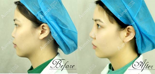 长沙亚韩做射极峰隆鼻术后效果 长沙亚韩做射极峰隆鼻术后效果