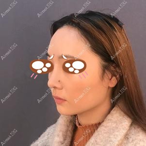 党宁医生做耳软骨隆鼻1个月效果 党宁医生做耳软骨隆鼻1个月效果