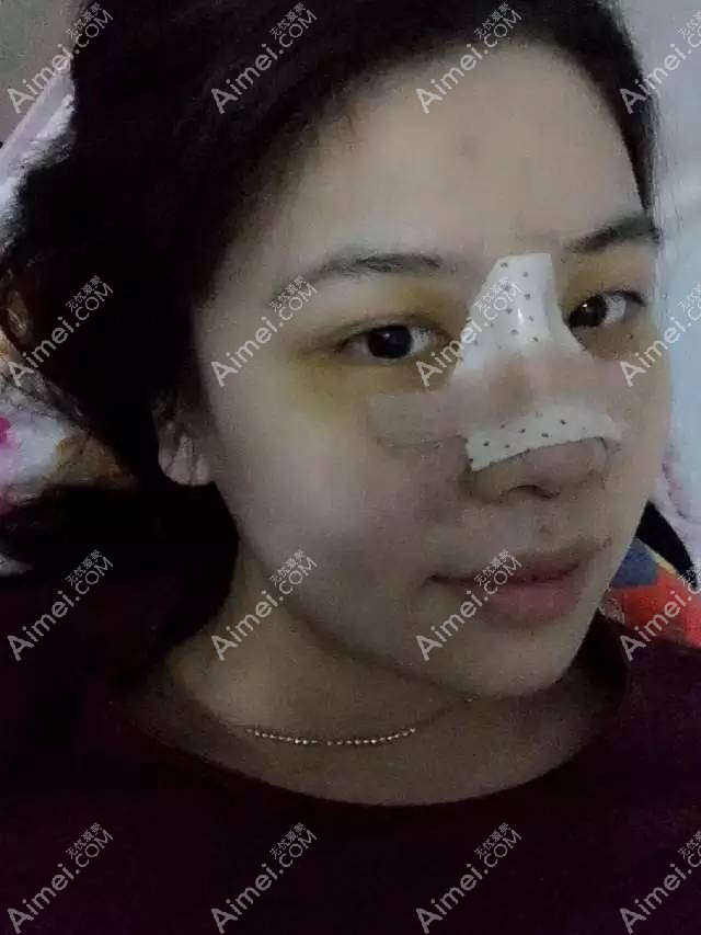 射极峰隆鼻第五天恢复 射极峰隆鼻第五天恢复