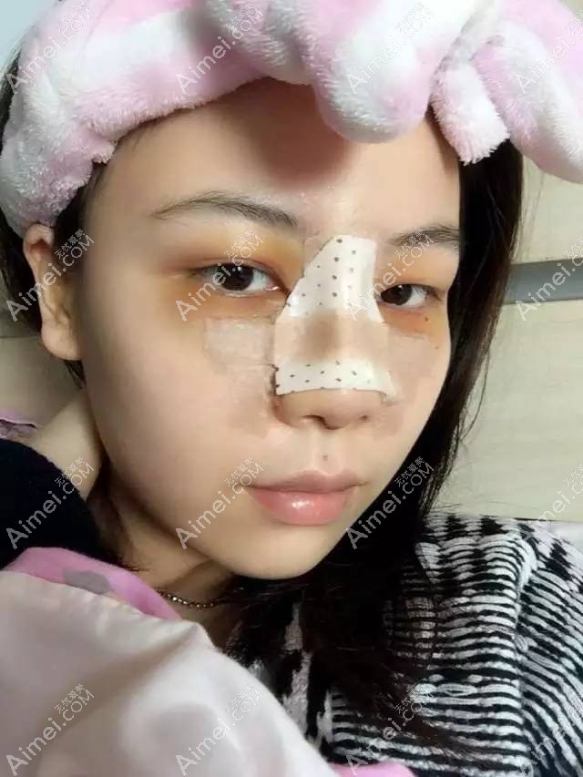 隆鼻第四天了,眼角从原来的红变成现在的黄 隆鼻第四天了,眼角从原来的红变成现在的黄