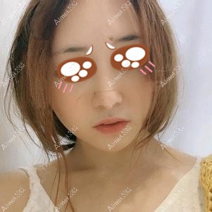 在党宁医生做耳软骨隆鼻术后3个月 在党宁医生做耳软骨隆鼻术后3个月