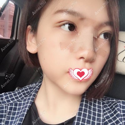 江门华美眼鼻整形术后7天恢复图 江门华美眼鼻整形术后7天恢复图