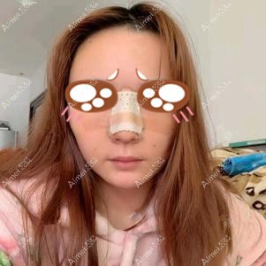 在重庆联合丽格做耳软骨隆鼻术后5天 在重庆联合丽格做耳软骨隆鼻术后5天