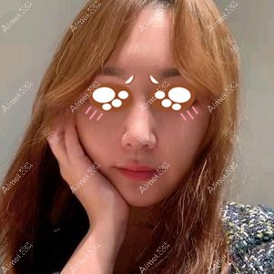 在党宁医生做耳软骨隆鼻术后7天恢复 在党宁医生做耳软骨隆鼻术后7天恢复