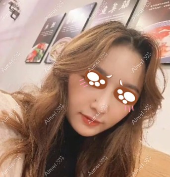 在党宁医生做耳软骨隆鼻术后2周效果 在党宁医生做耳软骨隆鼻术后2周效果