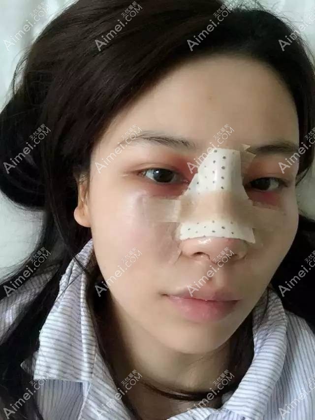 去掉鼻夹板以后的恢复情况 去掉鼻夹板以后的恢复情况