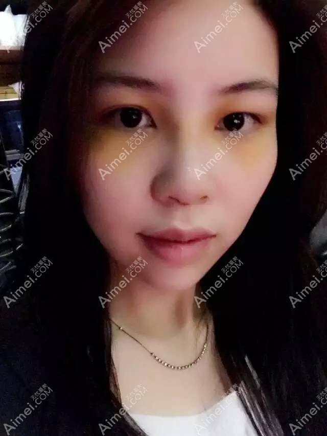 第六天隆鼻拆线后的效果 第六天隆鼻拆线后的效果