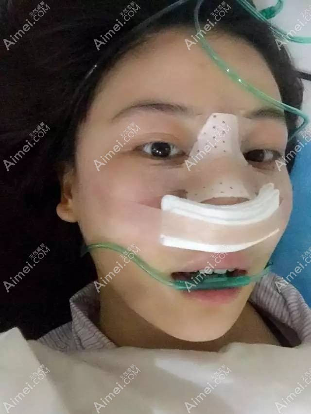 刚做完射极峰墨峰隆鼻效果 刚做完射极峰墨峰隆鼻效果