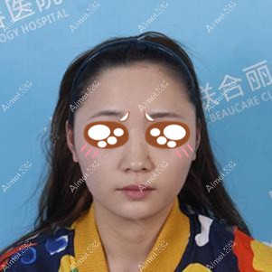 在重庆联合丽格做耳软骨隆鼻术前 在重庆联合丽格做耳软骨隆鼻术前