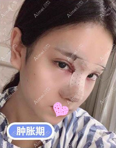 成都市西区医院邓东伟隆鼻案例 成都市西区医院邓东伟隆鼻案例