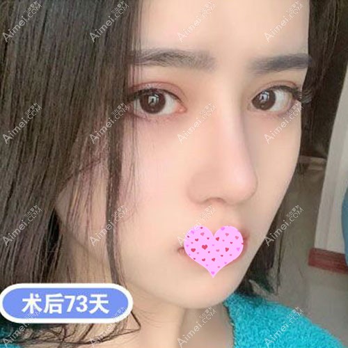 不知成都哪家医院做鼻子好,参考邓东伟案例 不知成都哪家医院做鼻子好,参考邓东伟案例