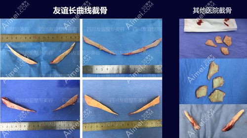 四川友谊长曲线截骨和普通下颌角截骨对比图 四川友谊长曲线截骨和普通下颌角截骨对比图