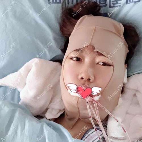 张立天磨骨术后即刻照片 张立天磨骨术后即刻照片