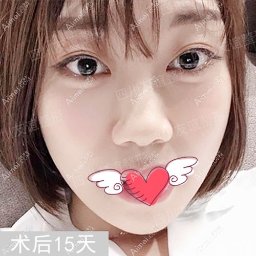 张立天磨骨术后15天恢复效果图 张立天磨骨术后15天恢复效果图