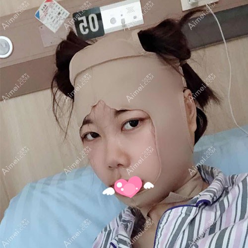 张立天颧骨下颌角磨骨术后3天恢复图 张立天颧骨下颌角磨骨术后3天恢复图