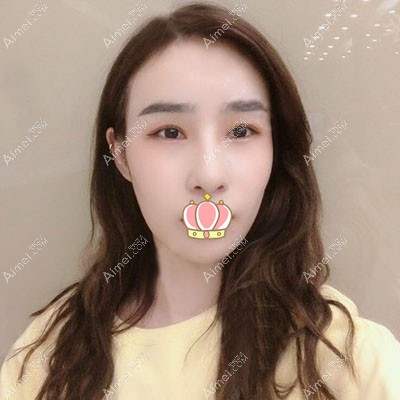 李光琴双眼皮失败修复术后效果图 李光琴双眼皮失败修复术后效果图