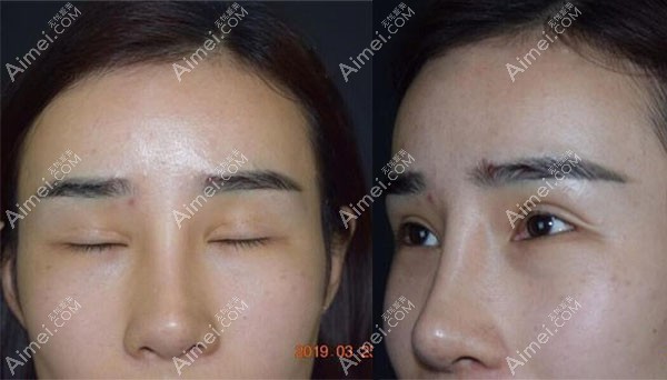 双眼皮凹陷疤痕修复案例 双眼皮凹陷疤痕修复案例