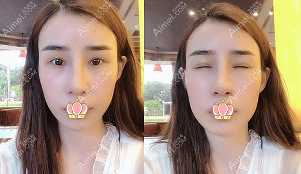 李光琴双眼皮修复案例7天恢复图 李光琴双眼皮修复案例7天恢复图