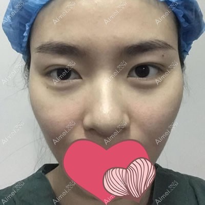 在邯郸京美做国产威宁假体隆鼻后,感觉效果不比韩士生科差