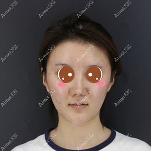 找郑荃医生做脂肪修复前 找郑荃医生做脂肪修复前