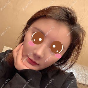 找郑荃医生做脂肪修复术后62天 找郑荃医生做脂肪修复术后62天