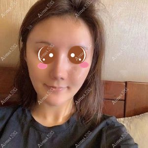 找郑荃医生做脂肪修复术后31天 找郑荃医生做脂肪修复术后31天