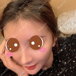 找郑荃医生做脂肪修复术后3个月 找郑荃医生做脂肪修复术后3个月