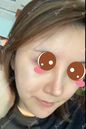 找郑荃医生做脂肪修复术后6天 找郑荃医生做脂肪修复术后6天