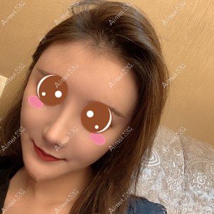 找郑荃医生做脂肪修复术后17天 找郑荃医生做脂肪修复术后17天