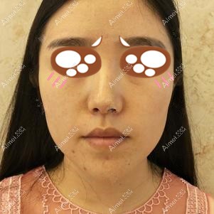 在重庆爱思特做下颌角手术前 在重庆爱思特做下颌角手术前