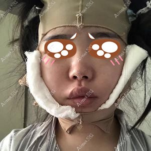 在重庆爱思特做下颌角手术后2天 在重庆爱思特做下颌角手术后2天