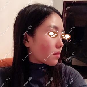 找重庆爱思特王涛做下颌角手术后2个月 找重庆爱思特王涛做下颌角手术后2个月