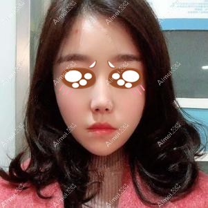 找重庆爱思特王涛做下颌角手术后6个月 找重庆爱思特王涛做下颌角手术后6个月