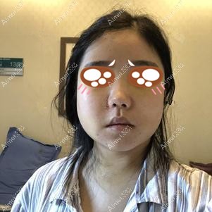 在重庆爱思特做下颌角手术后5天 在重庆爱思特做下颌角手术后5天