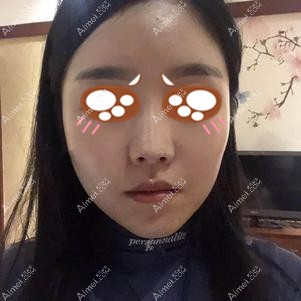 在重庆爱思特做下颌角手术后42天 在重庆爱思特做下颌角手术后42天