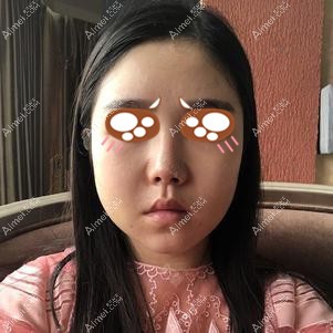 在重庆爱思特做下颌角手术后11天 在重庆爱思特做下颌角手术后11天