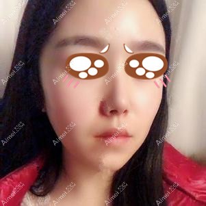 找重庆爱思特王涛做下颌角手术后3个月 找重庆爱思特王涛做下颌角手术后3个月