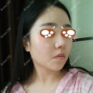 在重庆爱思特做下颌角手术后23天 在重庆爱思特做下颌角手术后23天