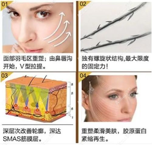 石冰院长带领的技术团队研发的青春宝埋线提升术.jpg 石冰院长带领的技术团队研发的青春宝埋线提升术.jpg