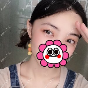 在重庆美圣美邦做双眼皮修复6个月 在重庆美圣美邦做双眼皮修复6个月