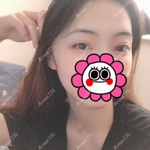 在重庆美圣美邦做双眼皮修复2个月 在重庆美圣美邦做双眼皮修复2个月